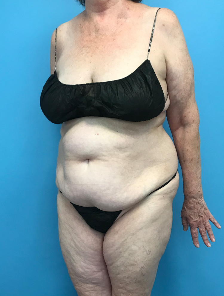 Side angled view of a woman's body before tummy tuck surgery, illustrating loose skin and excess fat in the abdomen.