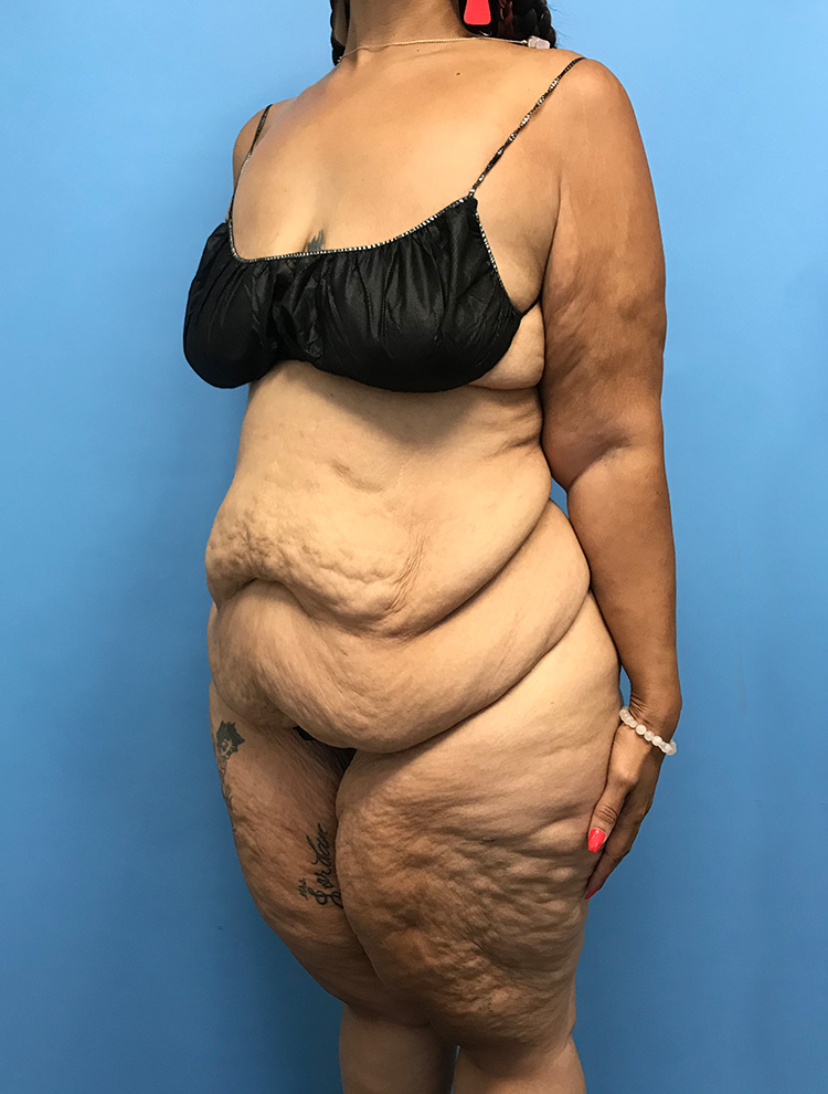 An angled side view of a female patient before tummy tuck surgery showing excess abdominal skin and volume