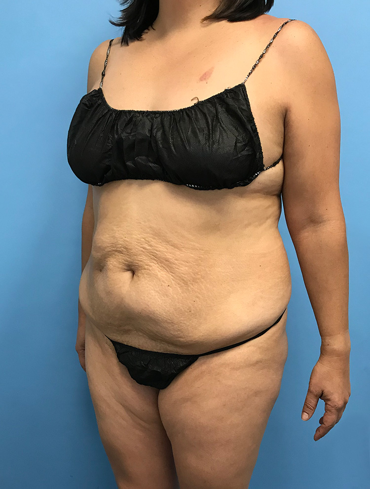 Front-angle view of a woman's abdomen before tummy tuck surgery, showing excess skin and uneven