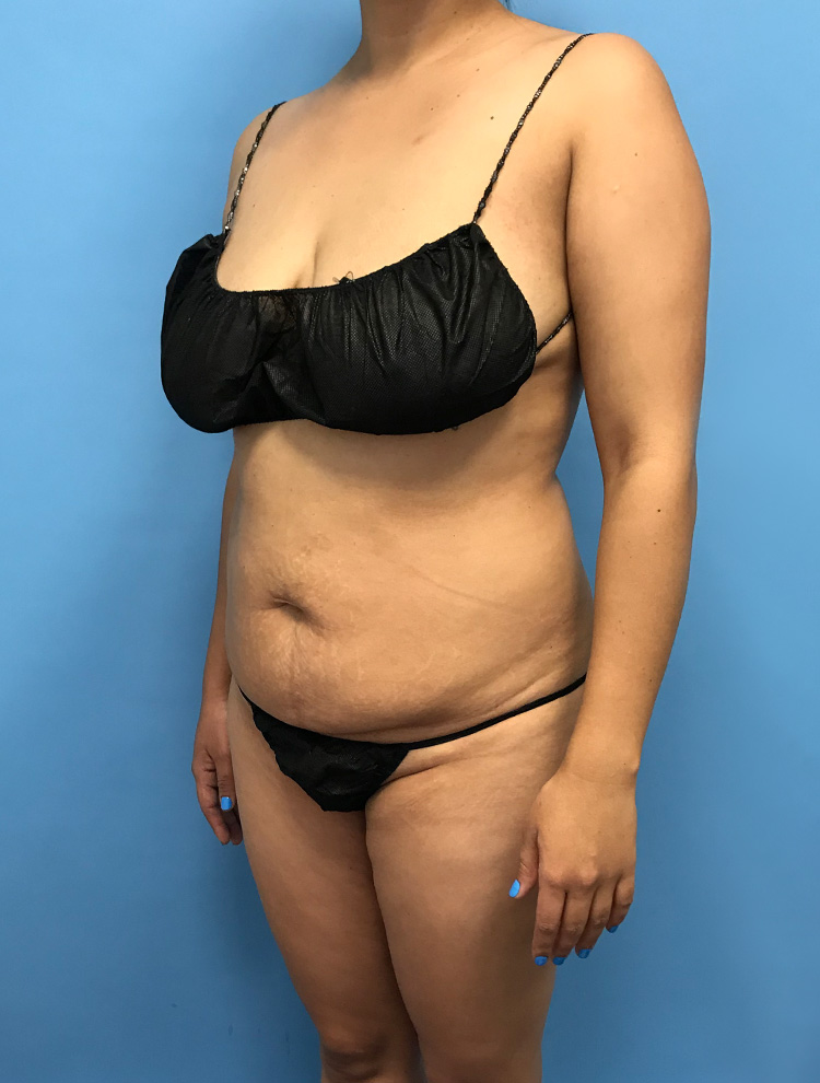 Angled view of a woman's abdomen showcasing results after tummy tuck surgery.