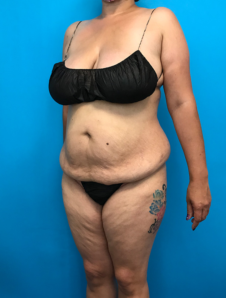 Angled side view of a woman's abdomen before tummy tuck surgery, highlighting excess skin and fat