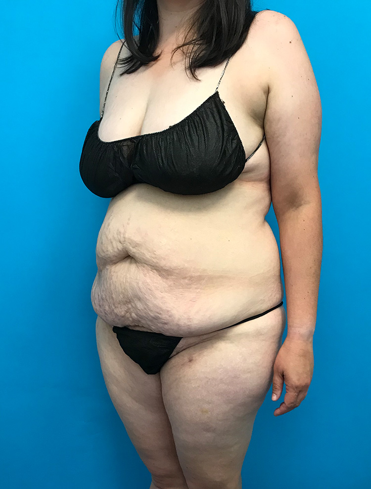 Angled view of a woman's body before tummy tuck surgery, showing excess abdominal skin and tissue.