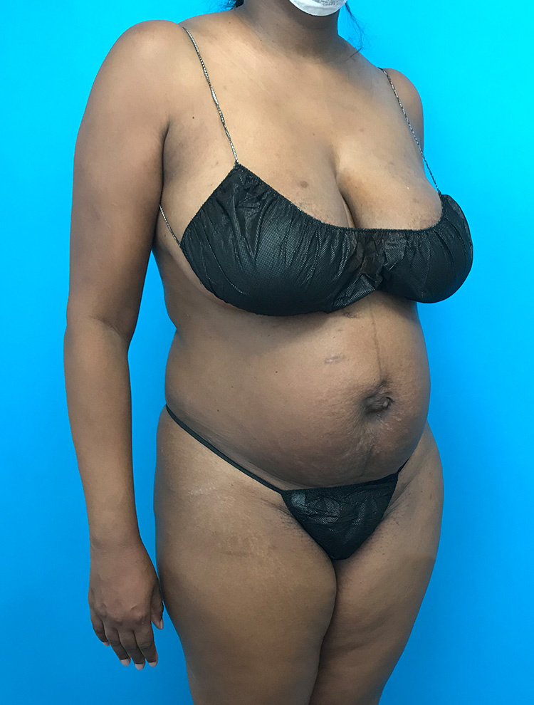 Patient showing side view before tummy tuck surgery, with visible abdominal area and excess skin.