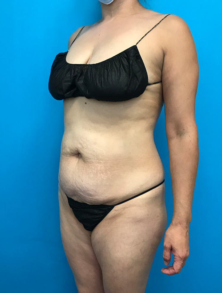 Patient showing side view before tummy tuck surgery, with visible abdominal area and skin laxity.