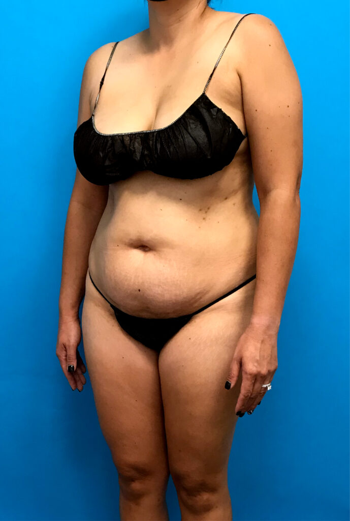 Case TTK-0789 before photo — Dr. Cat, Beverly Hills