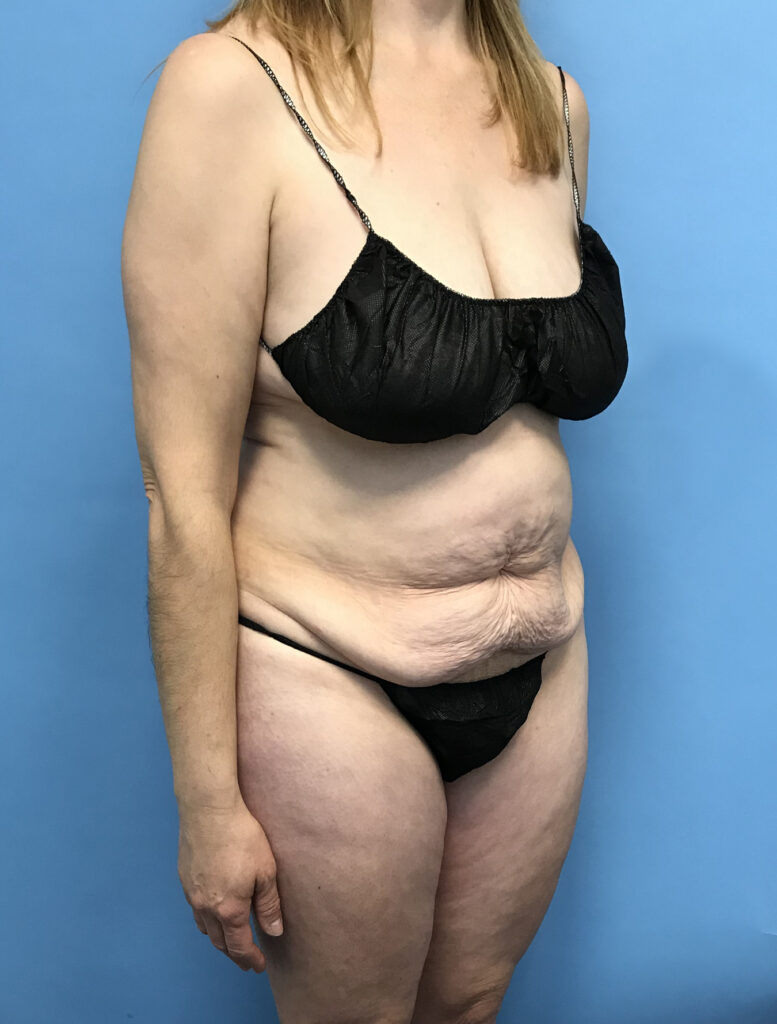 Case TTK-0819 before photo — Dr. Cat, Beverly Hills