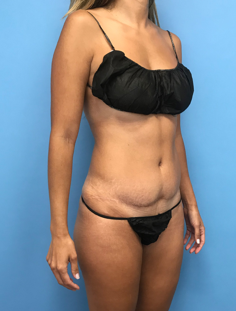 Front left-angle view of a woman's abdomen showcasing results after tummy tuck surgery.