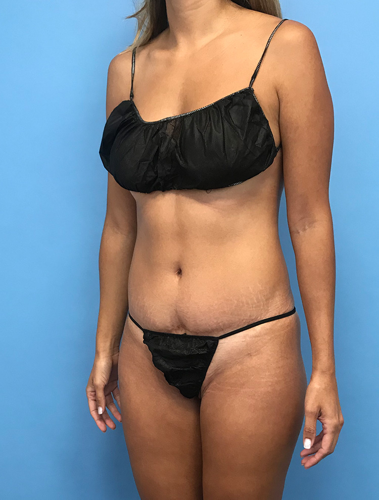 Front right-angle view of a woman's abdomen showcasing results after tummy tuck surgery.