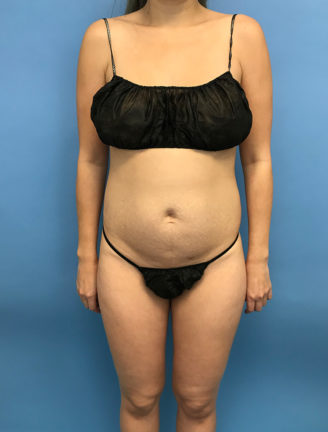 Front view of a woman before undergoing tummy tuck surgery