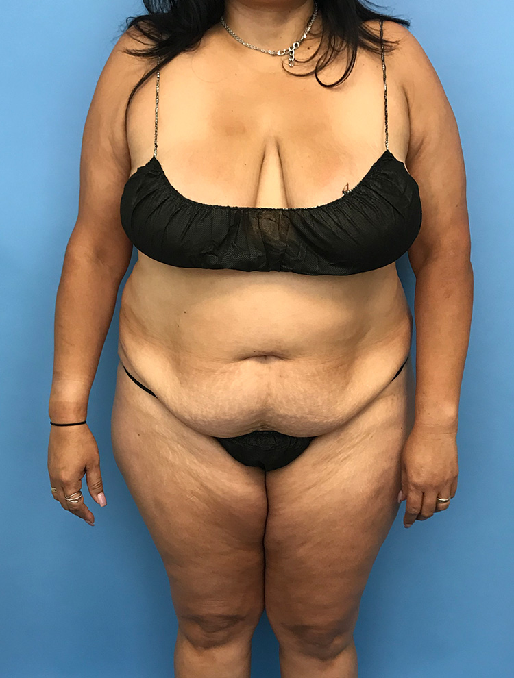 Tummy Tuck before photo front view - Dr. Cat Beverly Hills