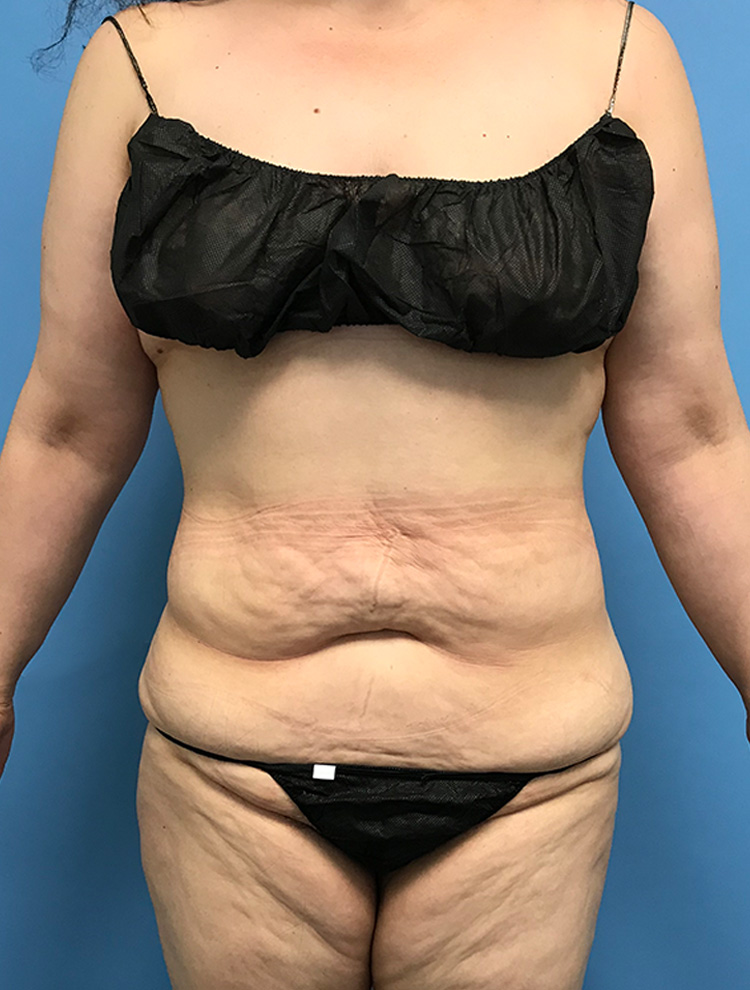 Tummy Tuck before photo front view - Dr. Cat Beverly Hills