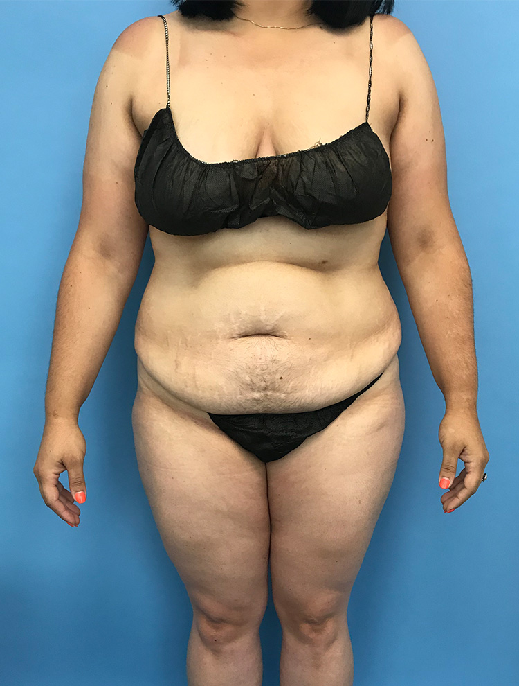 Tummy Tuck before photo front view - Dr. Cat Beverly Hills