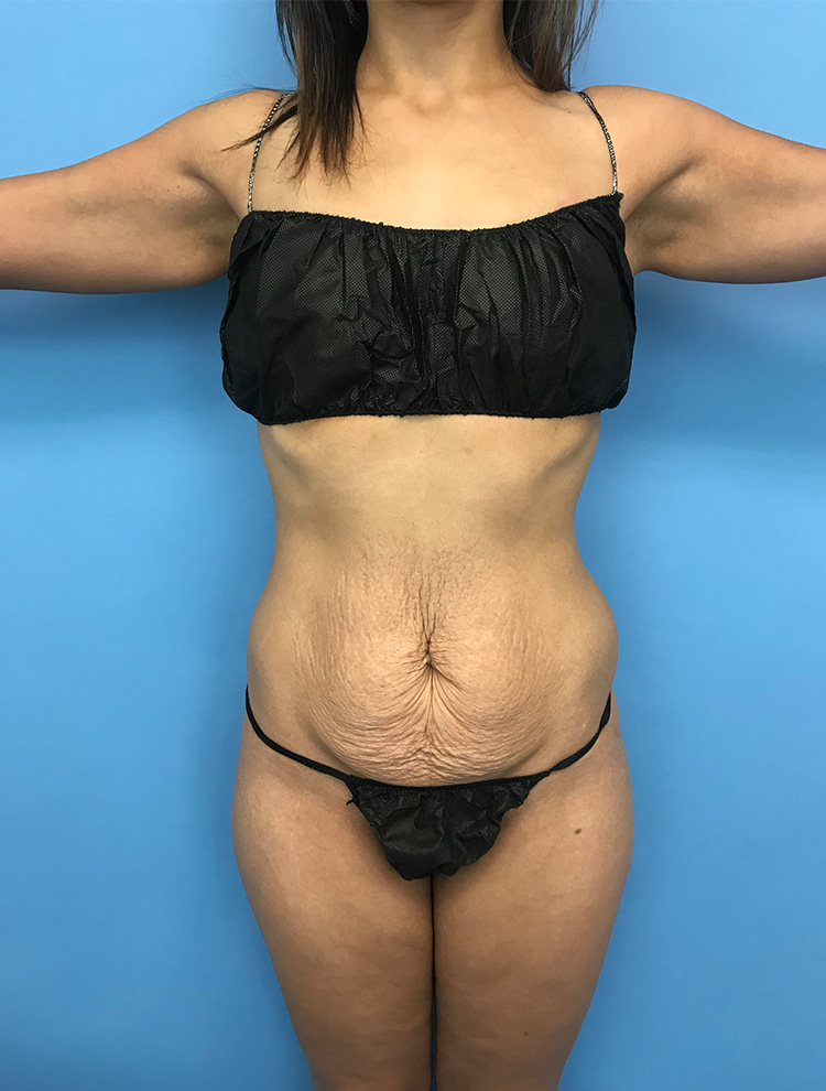 Tummy Tuck before photo front view - Dr. Cat Beverly Hills