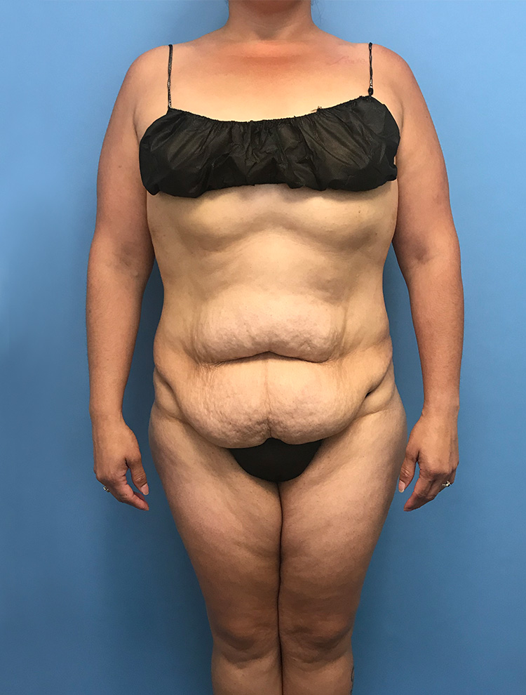 Tummy Tuck before photo front view - Dr. Cat Beverly Hills
