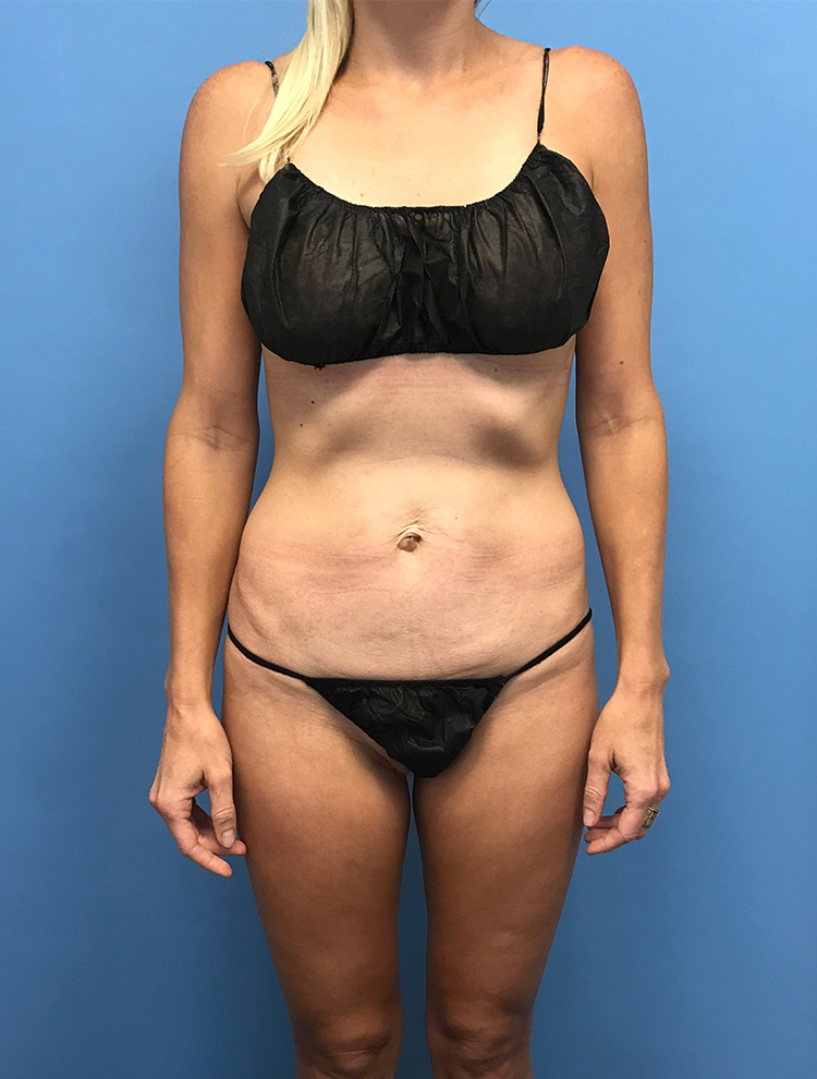 Tummy Tuck before photo front view - Dr. Cat Beverly Hills