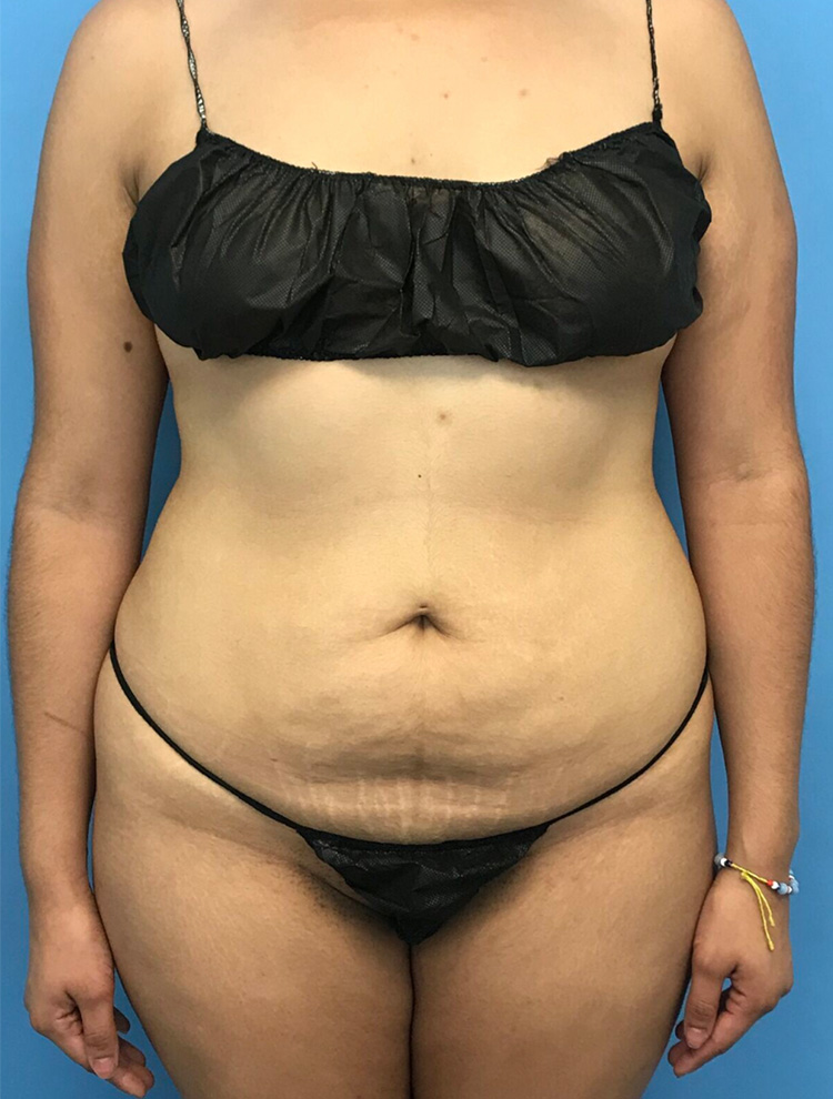 Before image of a tummy tuck procedure showing a woman's abdominal area with visible stretch marks.