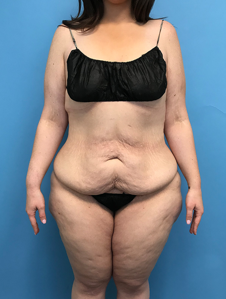 Tummy Tuck before photo front view - Dr. Cat Beverly Hills