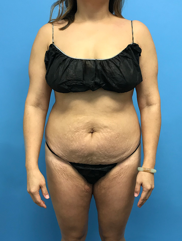 Before image of a tummy tuck procedure showing a woman's abdominal area with visible stretch marks.