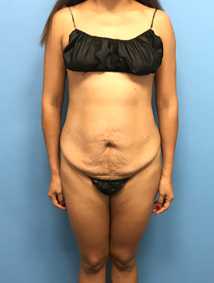 Front view of a woman before tummy tuck surgery showing loose abdominal skin and muscle laxity