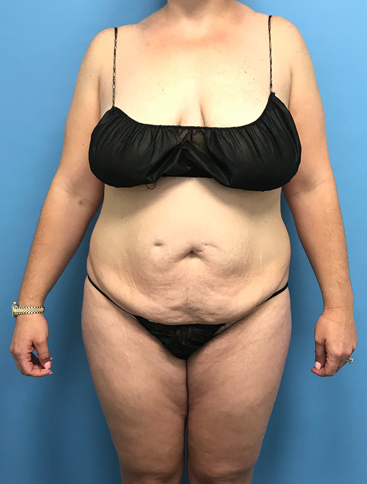 Front view of a woman before undergoing tummy tuck surgery.