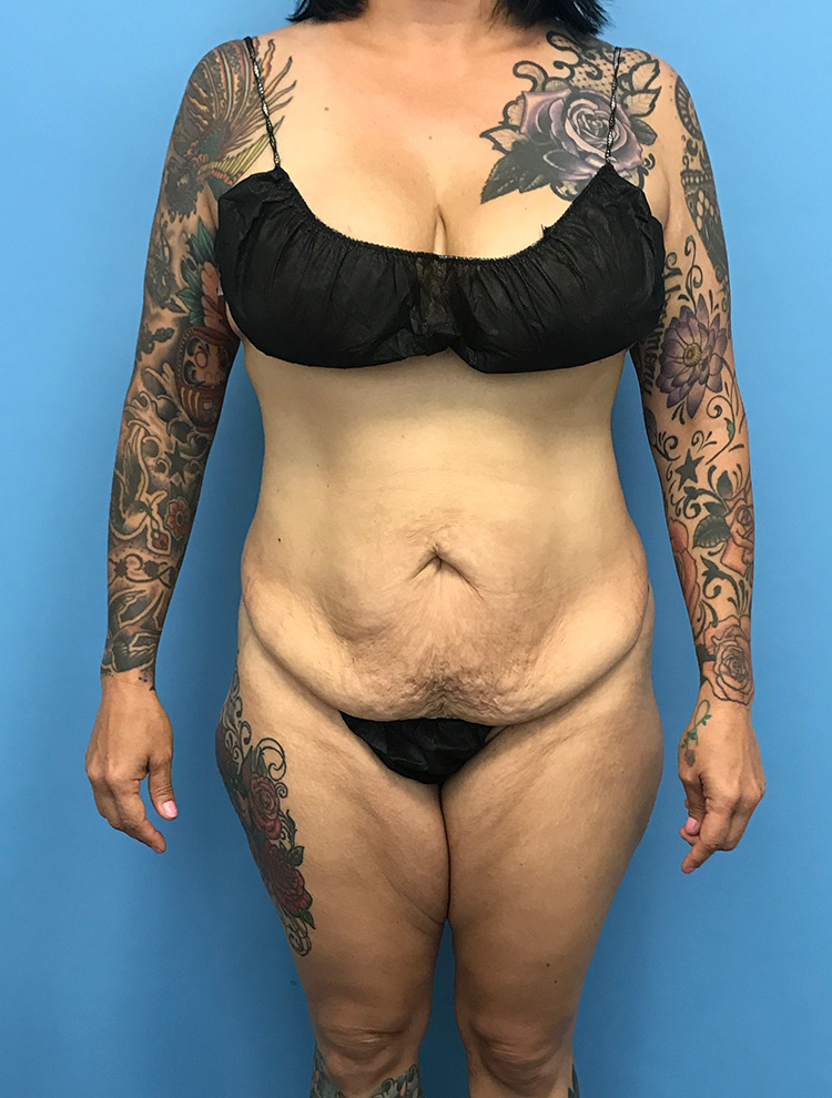 A front view of a tattooed female patient before tummy tuck surgery showing loose abdominal skin