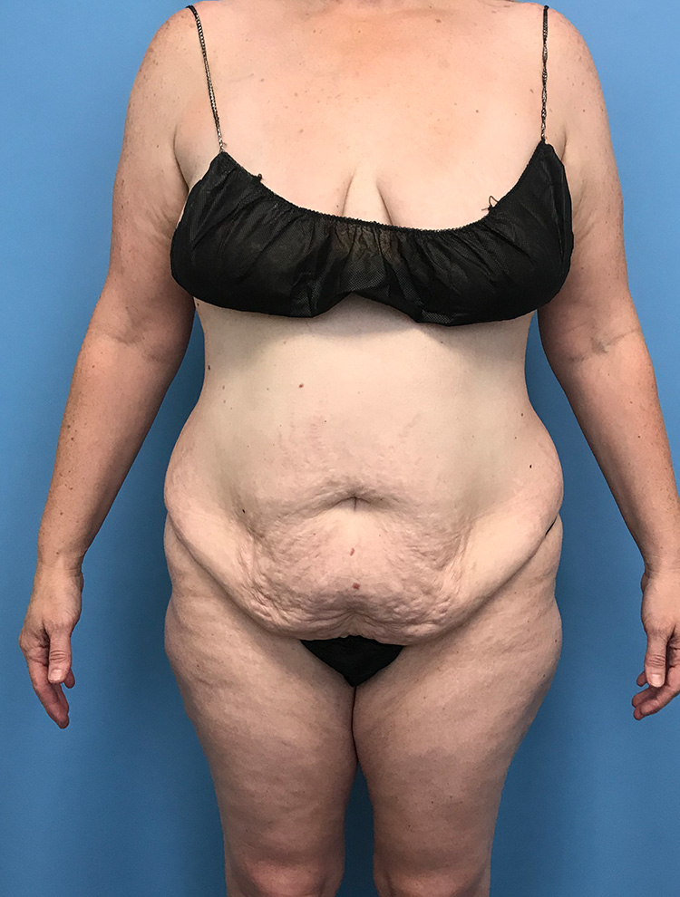 Front view of a woman's body before tummy tuck surgery, showing excess abdominal skin and tissue.