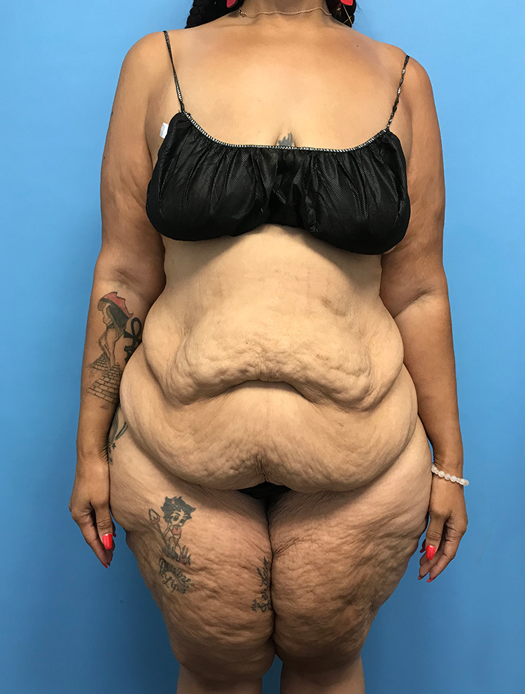 A front view of a female patient before tummy tuck surgery showing excess abdominal skin and volume