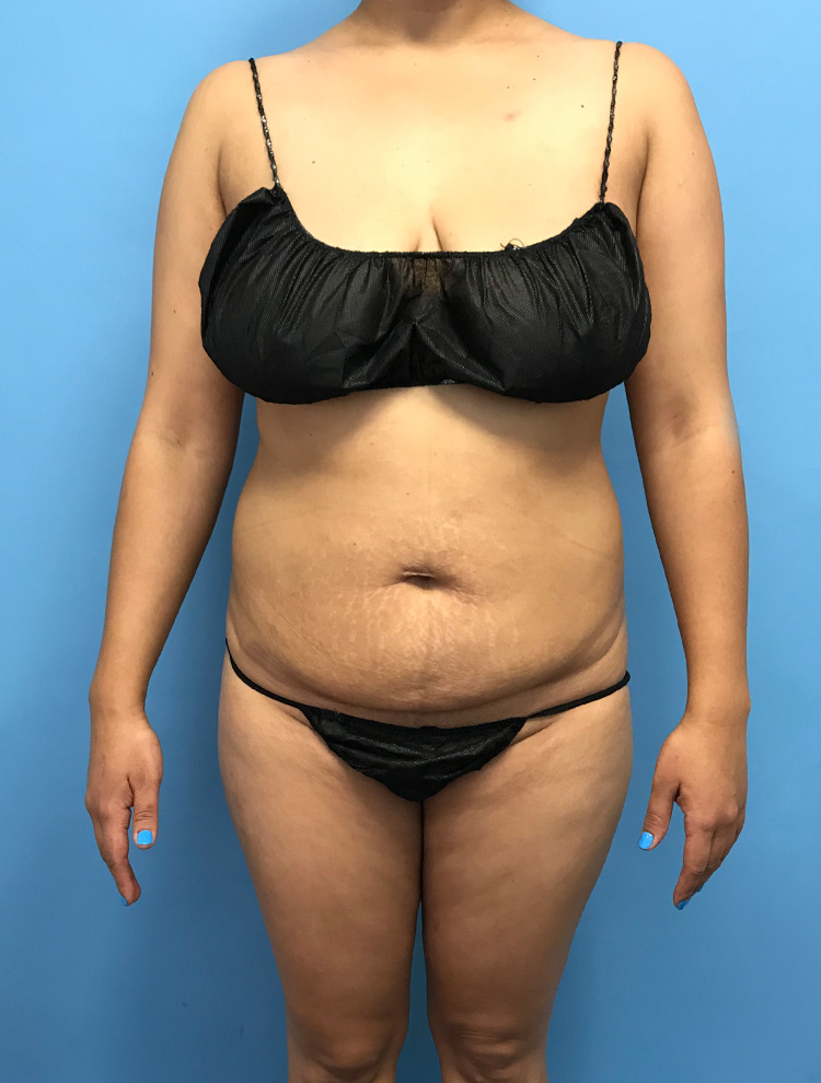 Tummy Tuck before photo front view - Dr. Cat Beverly Hills