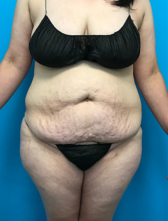 Front view of a woman's abdomen before tummy tuck surgery.
