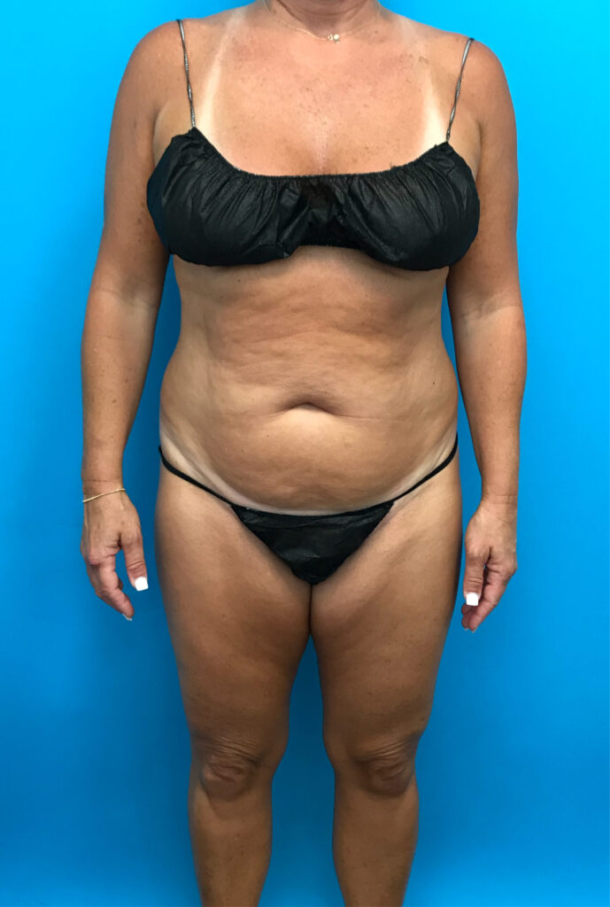 Case TTK-0759 before photo — Dr. Cat, Beverly Hills