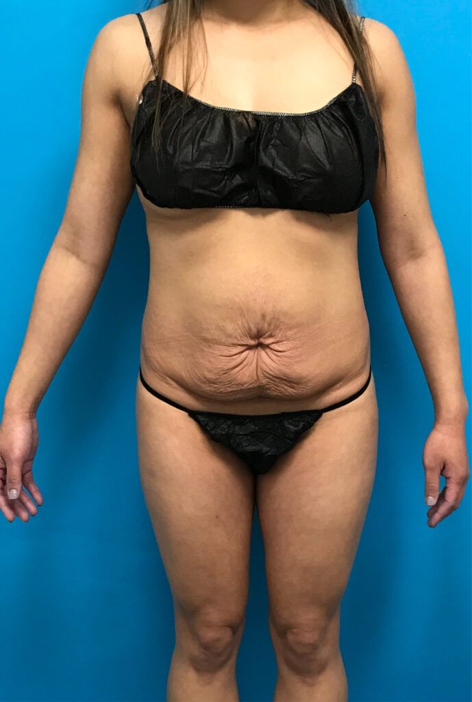 Case TTK-0806 before photo — Dr. Cat, Beverly Hills