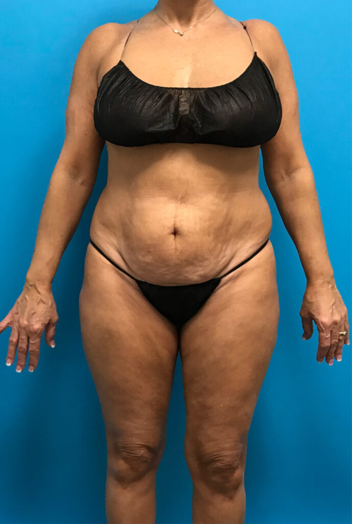 Case TTK-0815 before photo — Dr. Cat, Beverly Hills