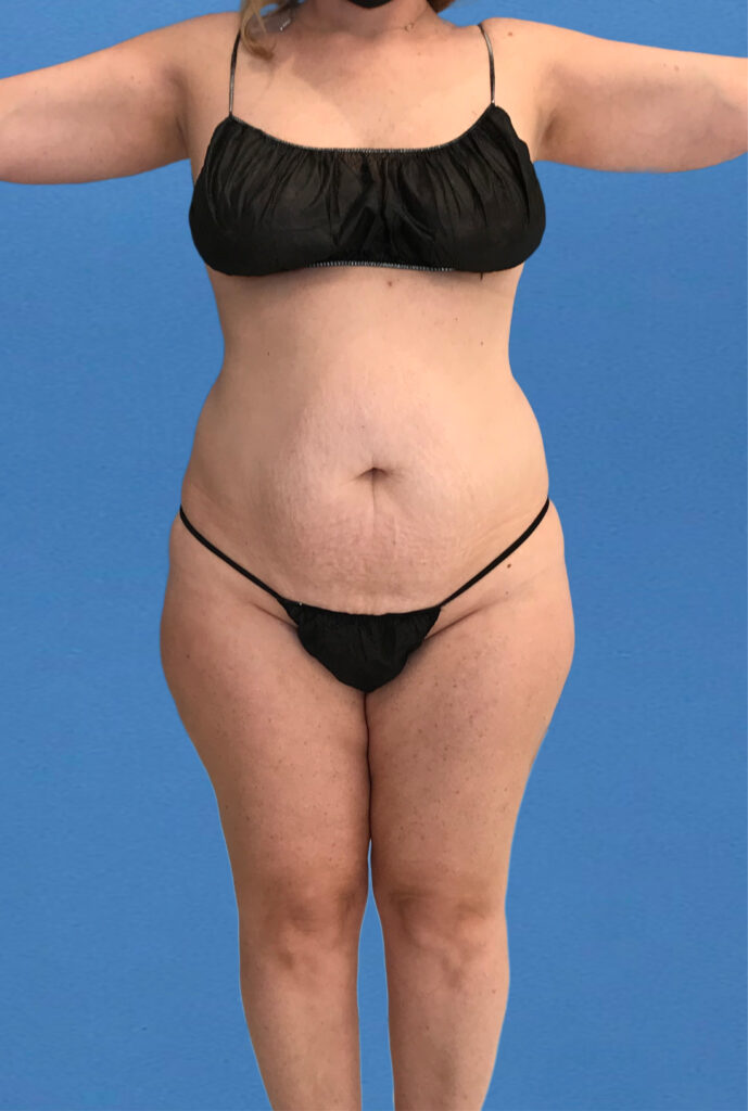 Case TTK-0831 before photo — Dr. Cat, Beverly Hills