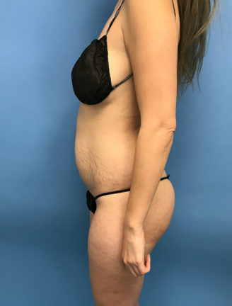 Side view of patient's abdomen before tummy tuck procedure showing excess skin and abdominal protrusion.