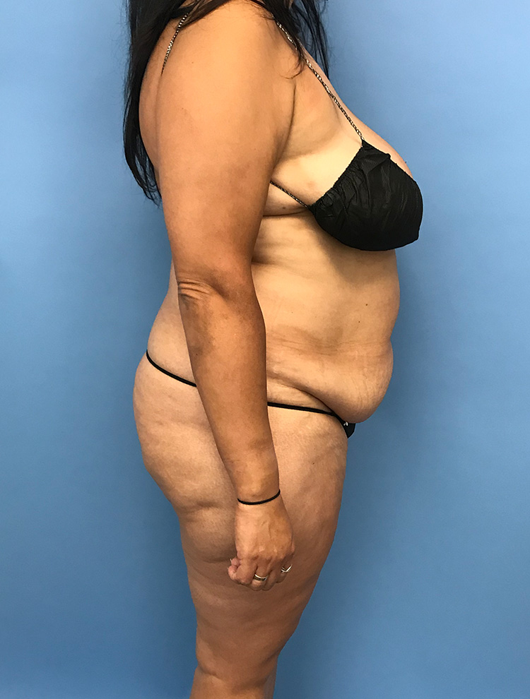 Tummy Tuck before photo side view - Dr. Cat Beverly Hills