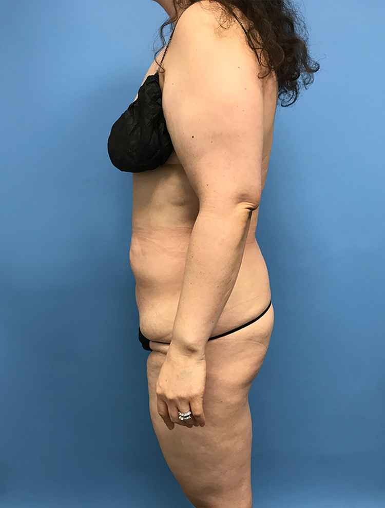 Tummy Tuck before photo side view - Dr. Cat Beverly Hills