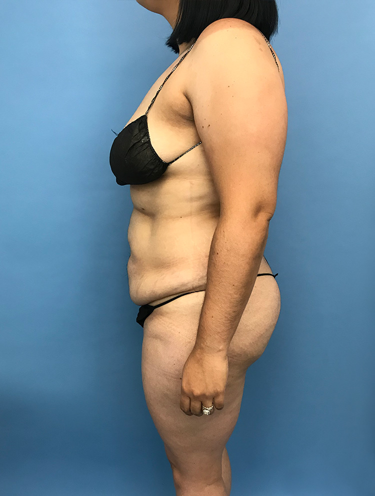 Tummy Tuck before photo side view - Dr. Cat Beverly Hills