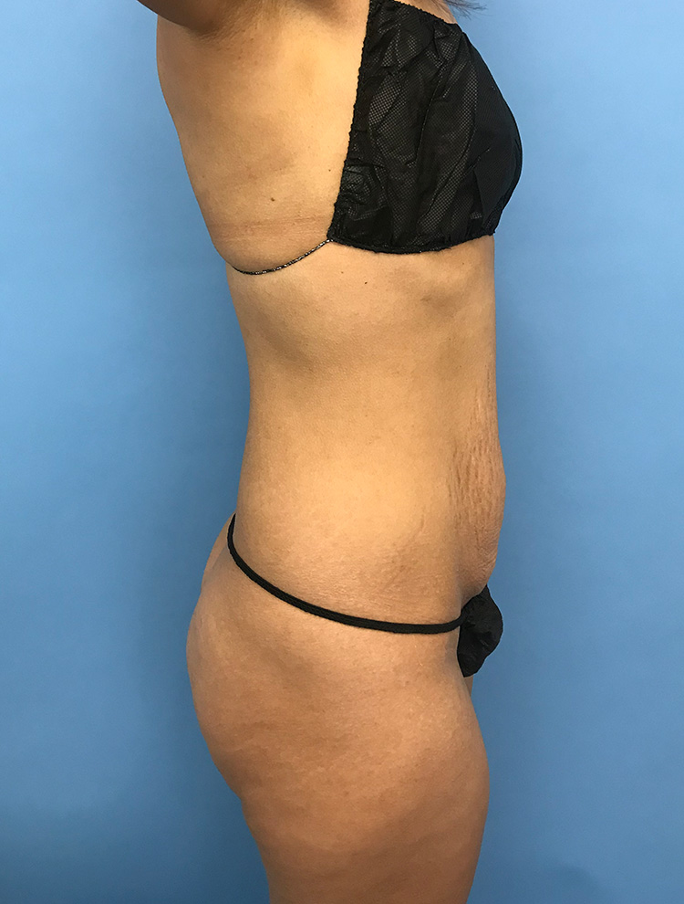 Tummy Tuck before photo side view - Dr. Cat Beverly Hills