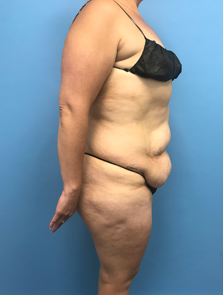 Tummy Tuck before photo side view - Dr. Cat Beverly Hills