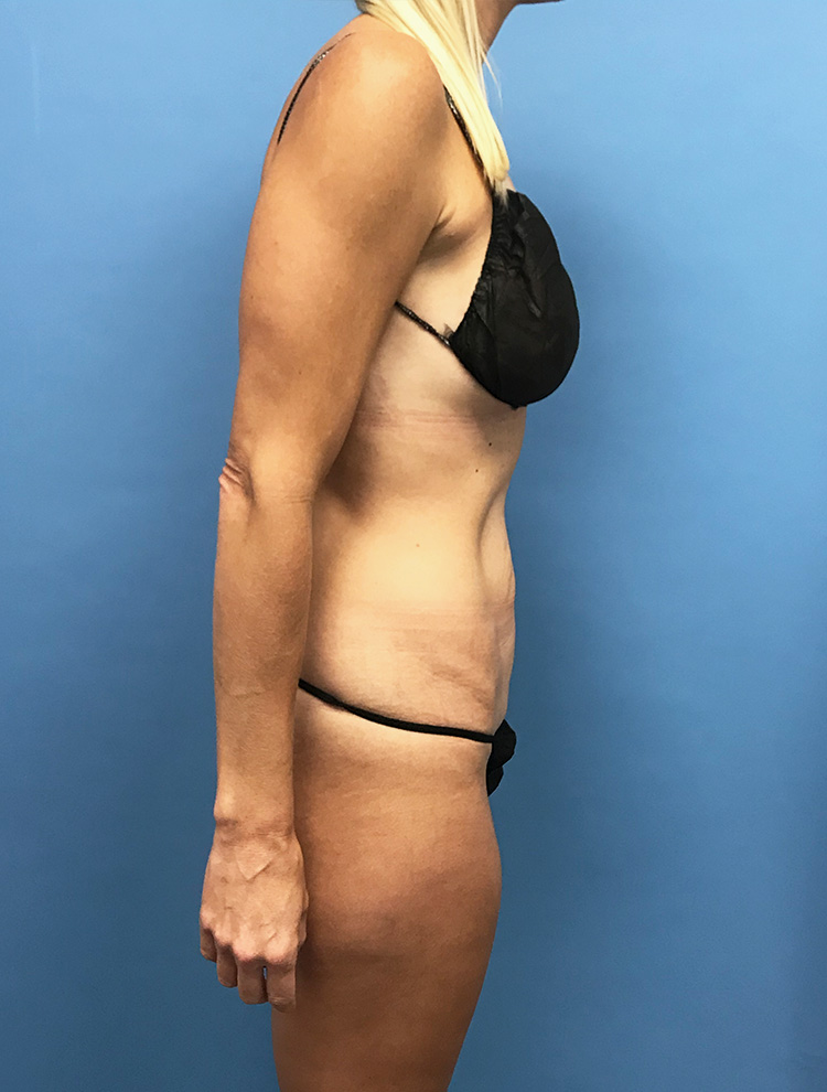 Tummy Tuck before photo side view - Dr. Cat Beverly Hills
