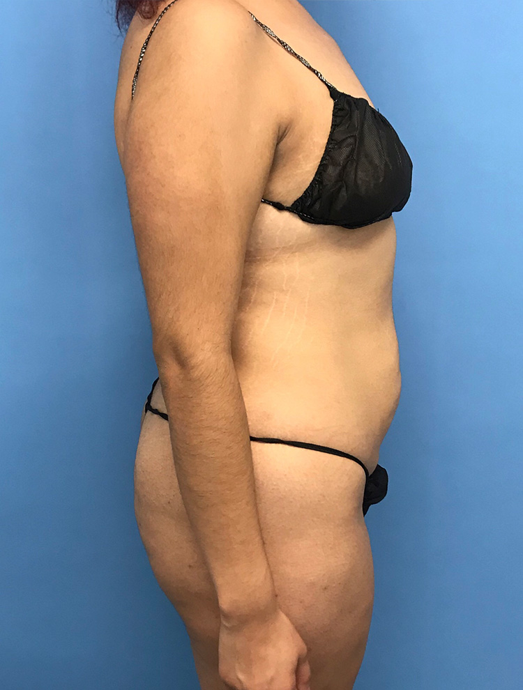 Side profile of woman's abdomen before tummy tuck procedure.