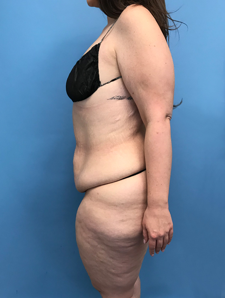 Tummy Tuck before photo side view - Dr. Cat Beverly Hills