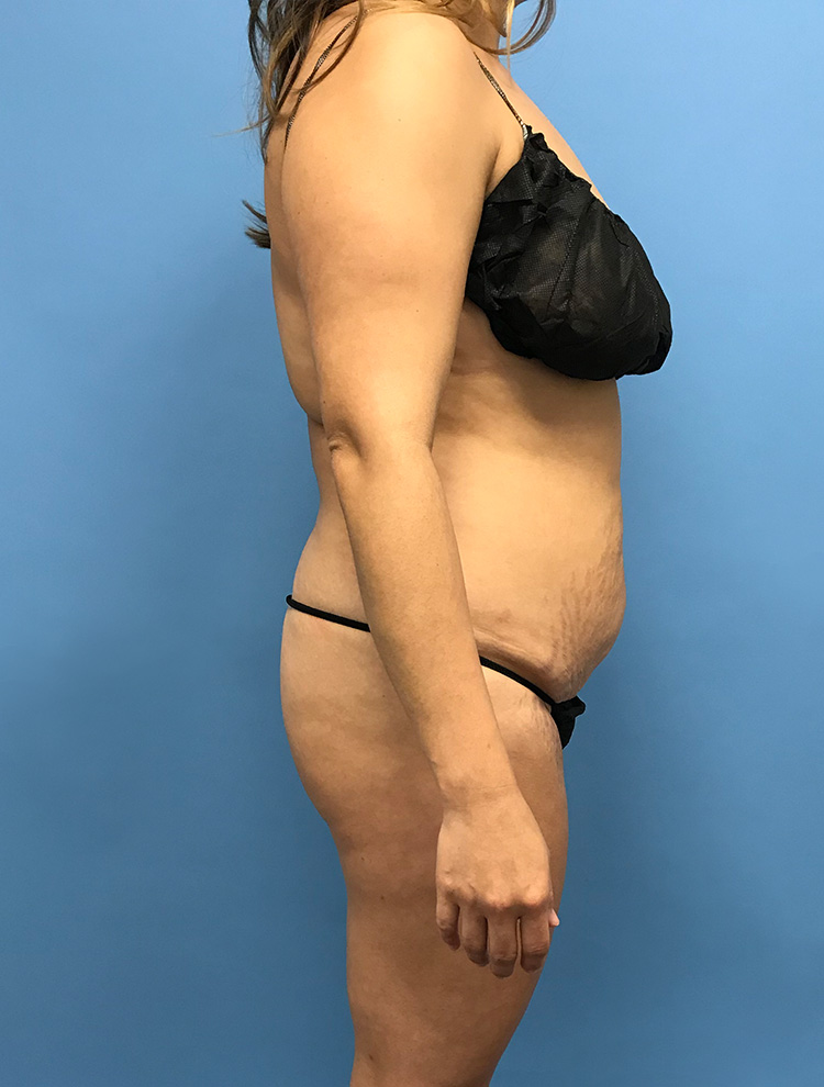 ASide profile of woman's abdomen before tummy tuck procedure.