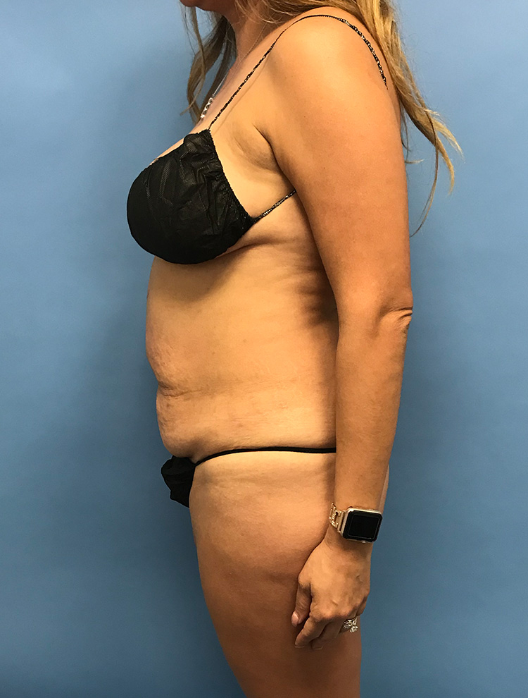 Side profile of a woman before undergoing tummy tuck surgery.