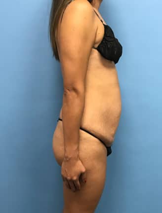 Tummy Tuck before photo side view - Dr. Cat Beverly Hills