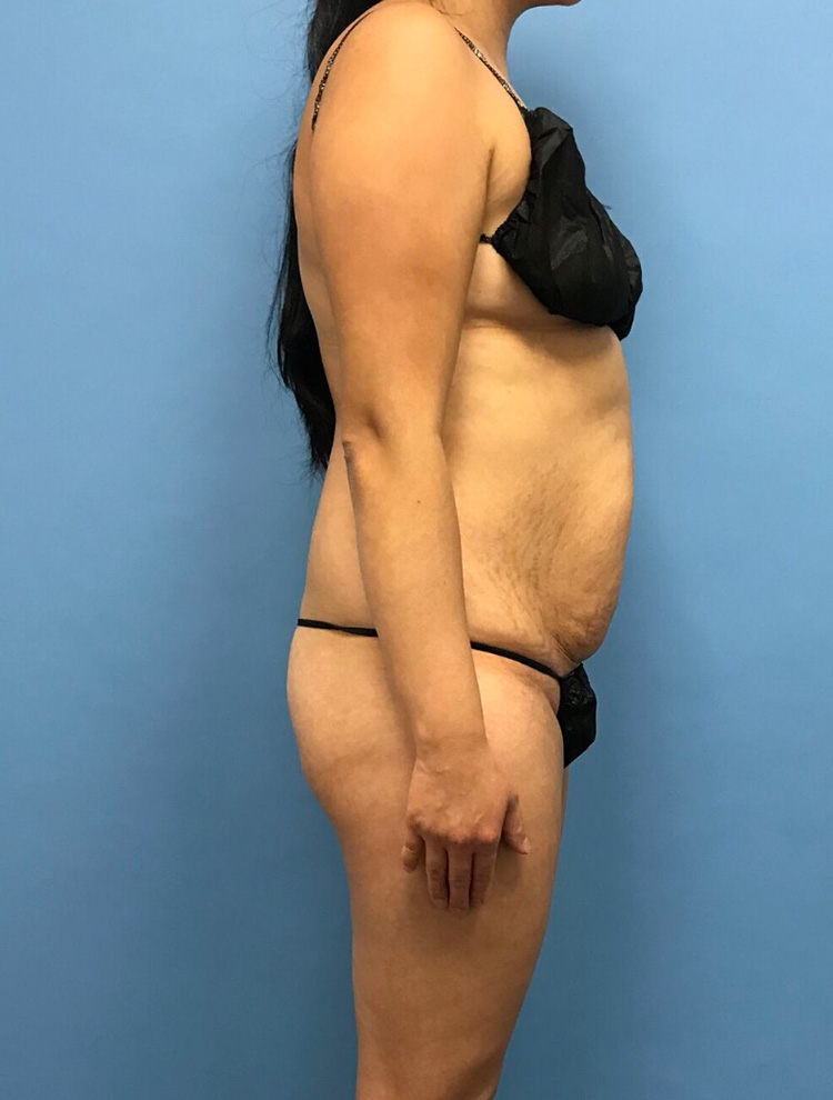 Profile view of a woman's body before cosmetic procedure, highlighting abdominal fullness and body areas targeted for contouring.
