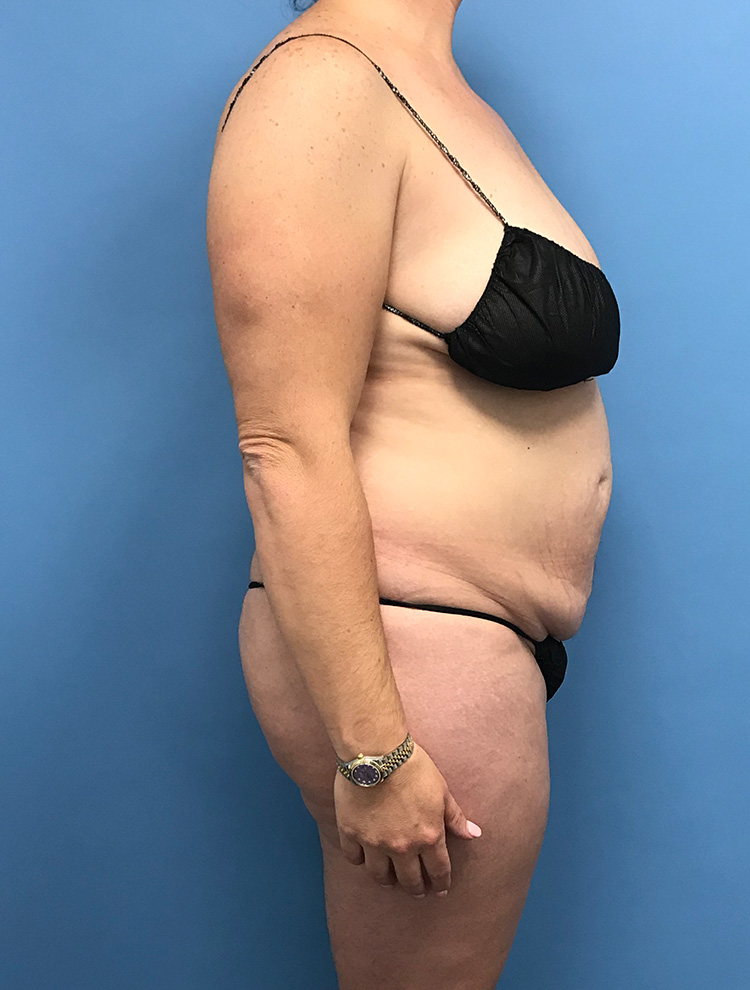 Side profile of a woman before undergoing tummy tuck surgery.
