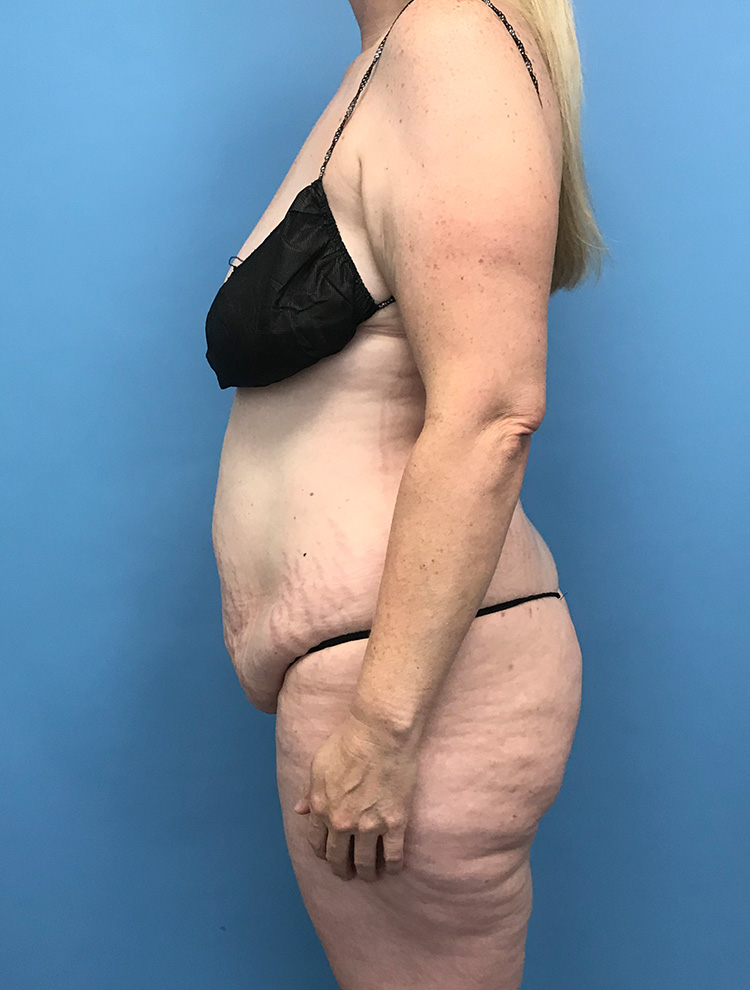 Side view of a woman's body before tummy tuck surgery, showing excess abdominal skin and tissue.