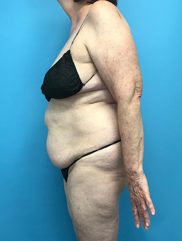 Side view of a woman's body before tummy tuck surgery, illustrating loose skin and excess fat in the abdomen.
