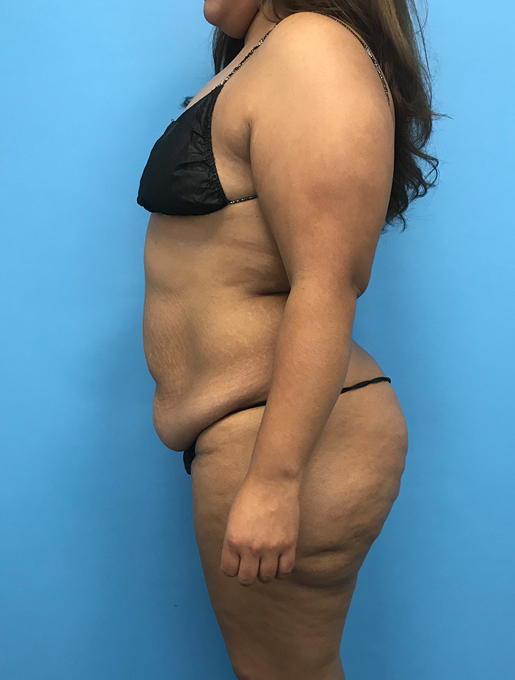 Side view of a woman before undergoing tummy tuck surgery, highlighting abdomen and waist area.